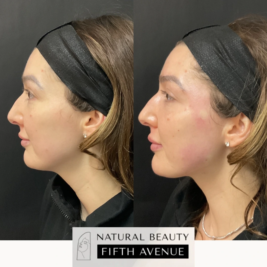 Before and after profile views showing dermal filler results enhancing facial contours
